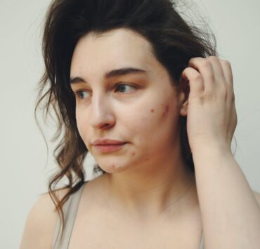 Femmeguru acne-fighting skincare