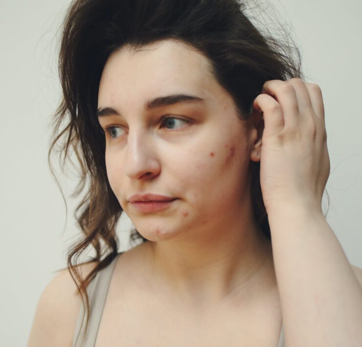 Femmeguru acne-fighting skincare