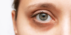 FEMMEGURU under eye fillers