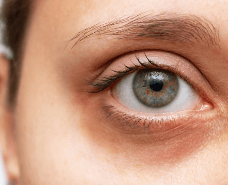 FEMMEGURU under eye fillers